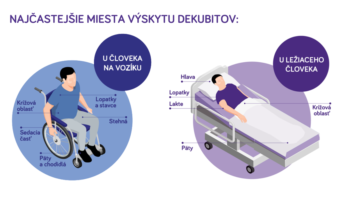 Najšastejšie miesta výskytu dekubitov